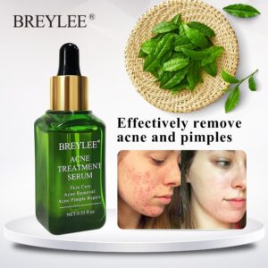 Acne Treatment Serum  Repair Pimple Remover